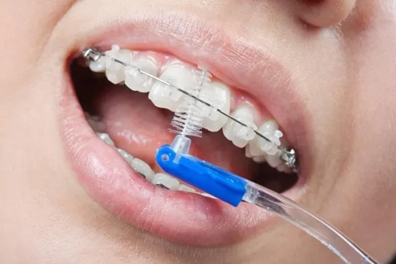 Plano odontológico cobre manutenção aparelho