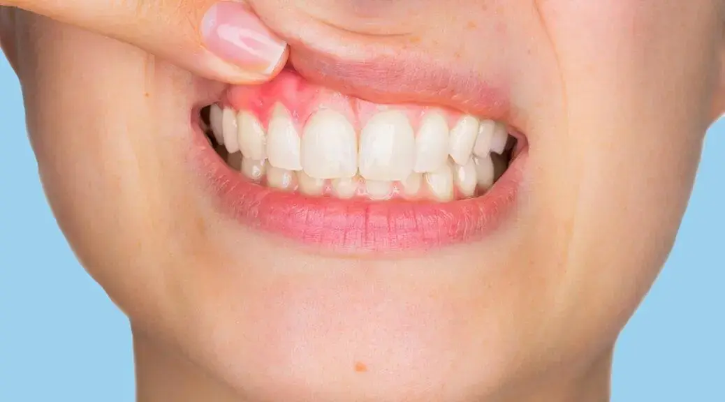 Alívio Caseiro para Dores de Dentes antes de Visitar o Dentista