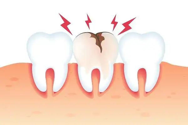 Causas Comuns das Dores de Dentes e Como Identificá-las