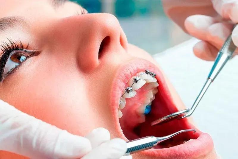 Aparelho Dental