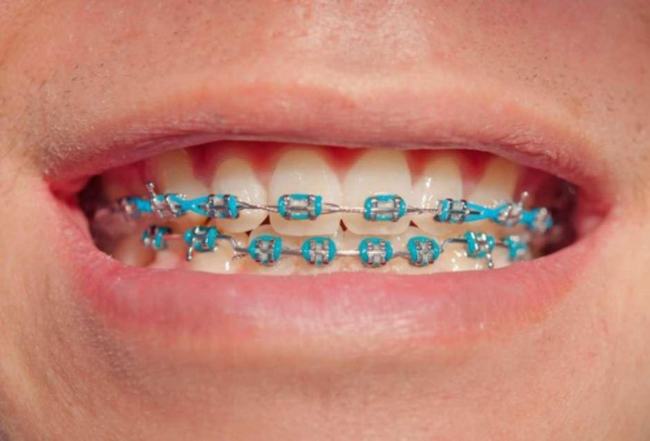 Aparelho Dental