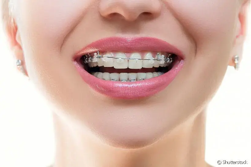 Escolhendo o Tipo Certo de Aparelho Dental Para Você
