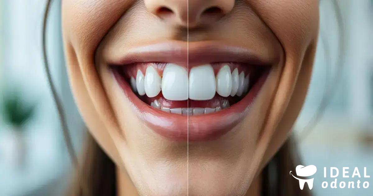 Diferenças entre lentes de contato dental e facetas Diferenças entre lentes de contato dental e facetas