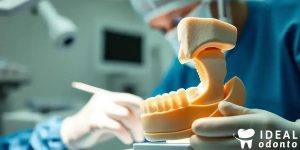Enxerto Ósseo: Técnica Sandwich para Defeitos Verticais