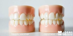 Faceta Dentária: Resina ou Cerâmica? Descubra Agora!