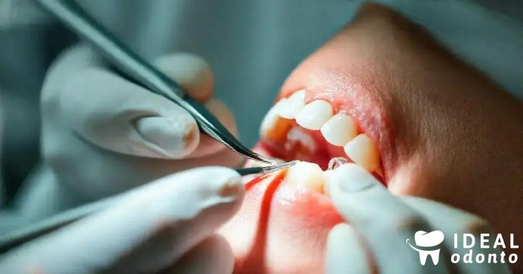 Fibra de Vidro na Reconstrução de Dentes: Guia Prático