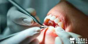 Fibra de Vidro na Reconstrução de Dentes: Guia Prático