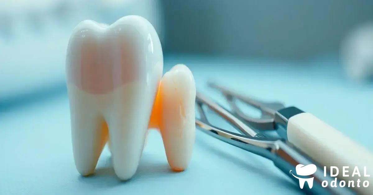 Tratamentos disponíveis para dente trincado