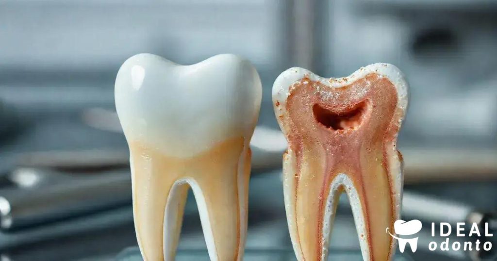 Tudo Sobre Reabsorção Dental: Interna e Externa