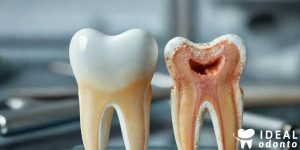Tudo Sobre Reabsorção Dental: Interna e Externa