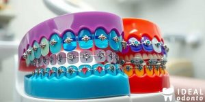 Cores do Aparelho Ortodôntico: Como Escolher a Melhor para Você