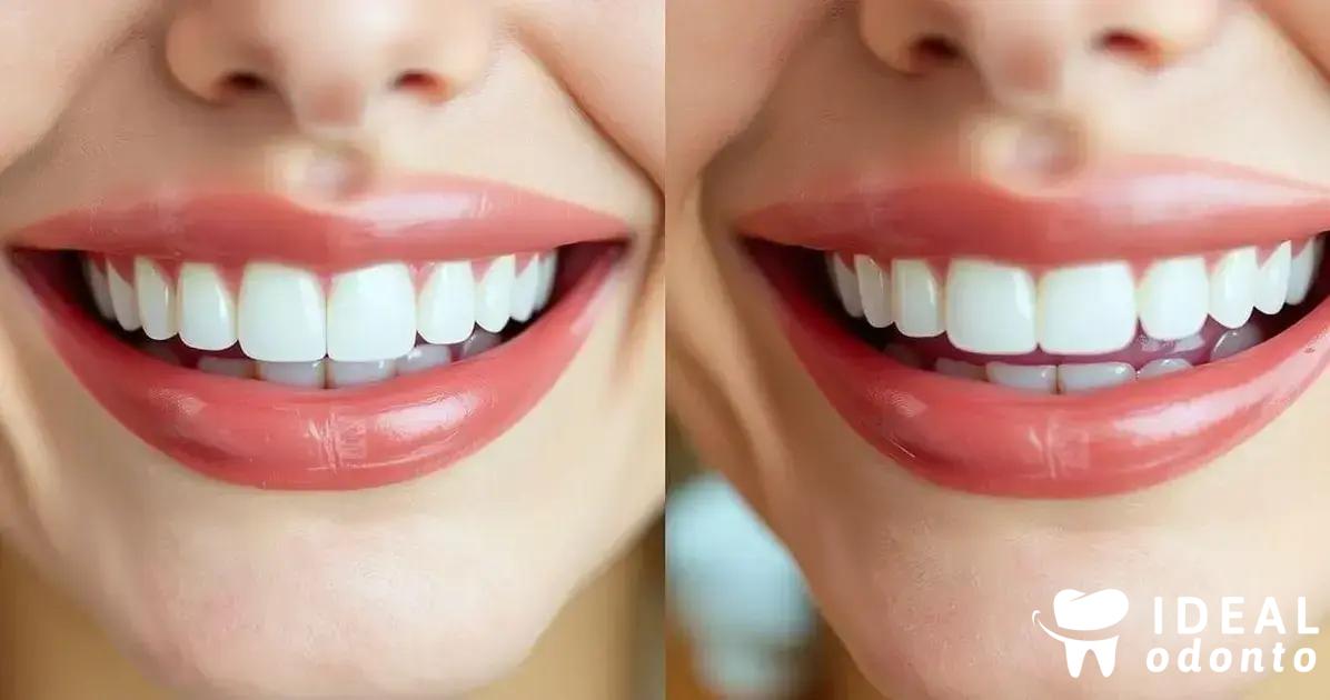 Diferenças entre facetas de resina e porcelana