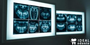8 Tipos de Radiografia Odontológica e Seus Benefícios