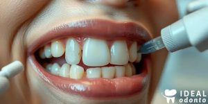 Fluorose Dentária: Causas e Tratamentos para Manchas Brancas