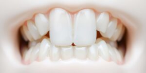 dentes faceta de resina