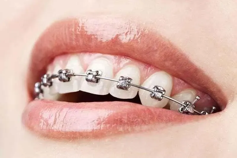 Plano dental que cobre aparelho