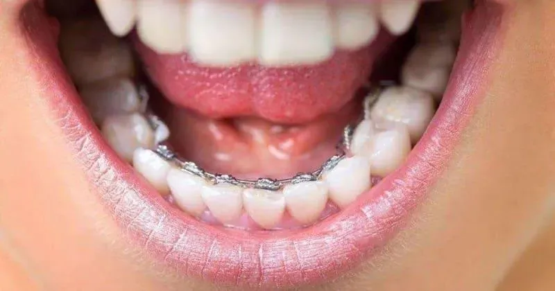 Plano odontológico aparelho