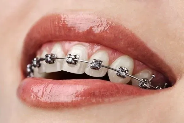 Plano odontológico com ortodontia